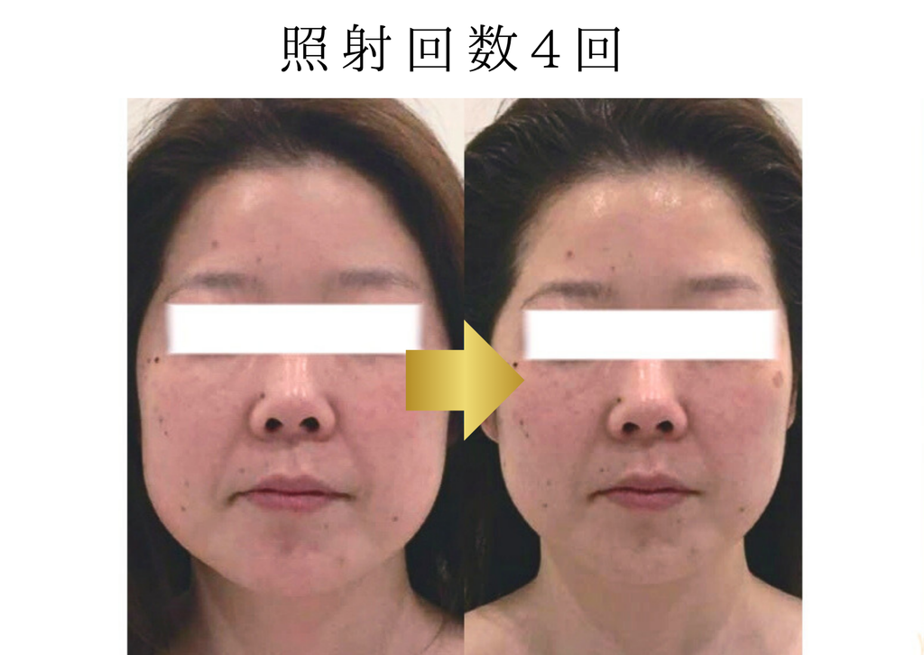 医療HIFU（ハイフ）の施術例｜照射4回の症例写真