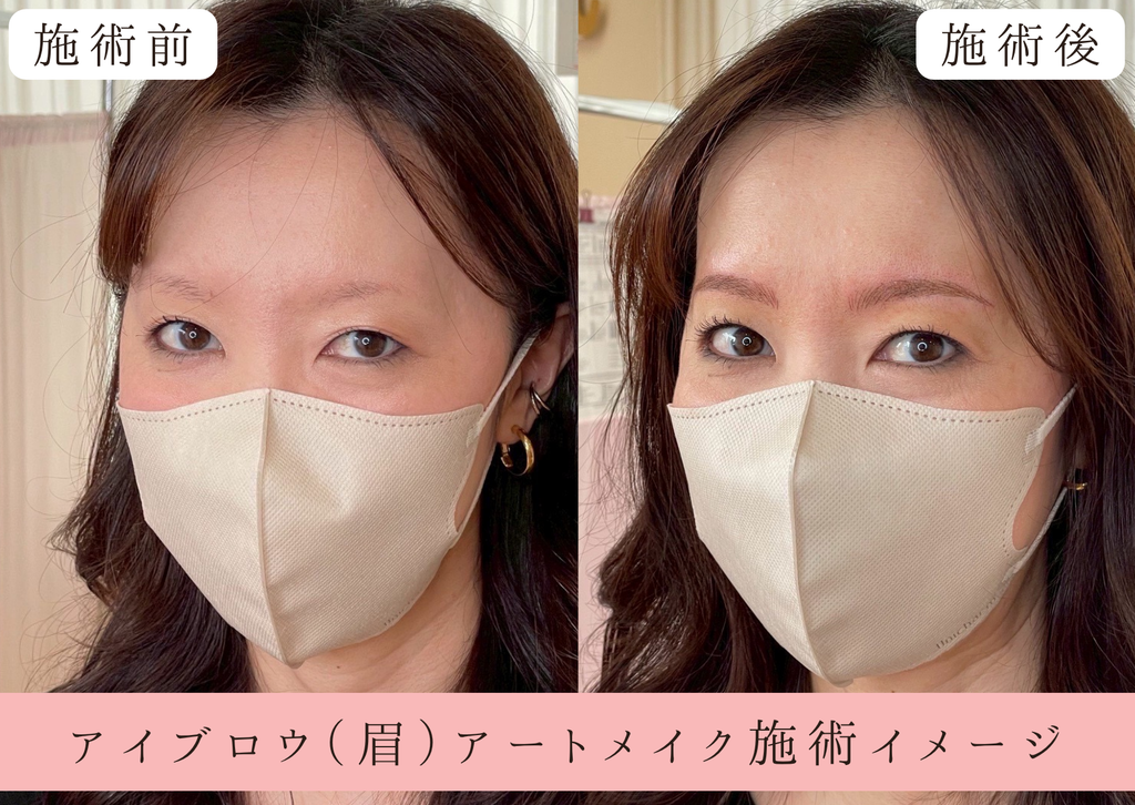 茨城県那珂市のさがわ皮膚科 医療アートメイク 眉・アイブロウ